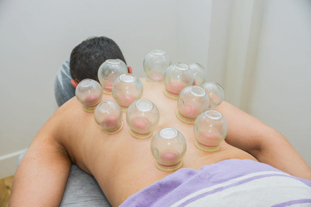 massage cupping ventouses